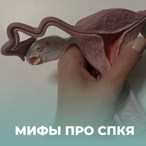 ТОП-3 мифов о синдроме поликистозных яичников (СПКЯ)