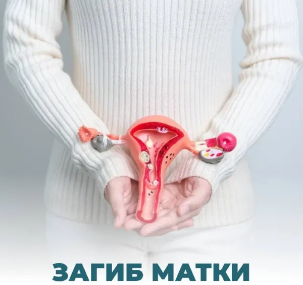 Загиб матки: бессимптомная патология или причина бесплодия?